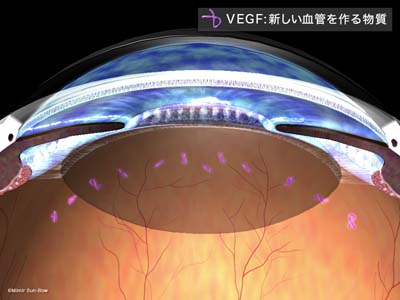 血管新生緑内障とは何ですか?