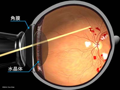 硝子体手術で糖尿病網膜症を治療できますか?
