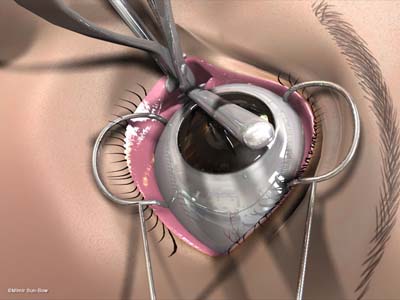 経結膜の眼窩減圧術２