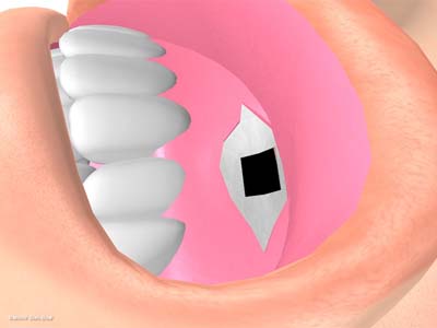 経上顎洞の眼窩減圧術１